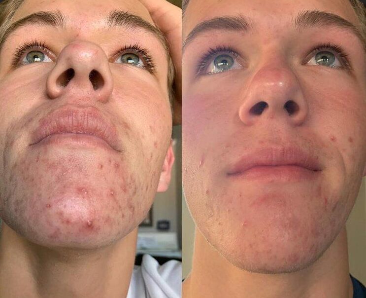 Avant / Après — Maxime, 16 ans