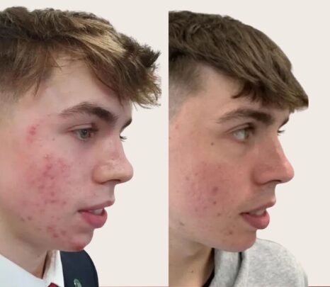 Avant / Après — Hugo, 15 ans
