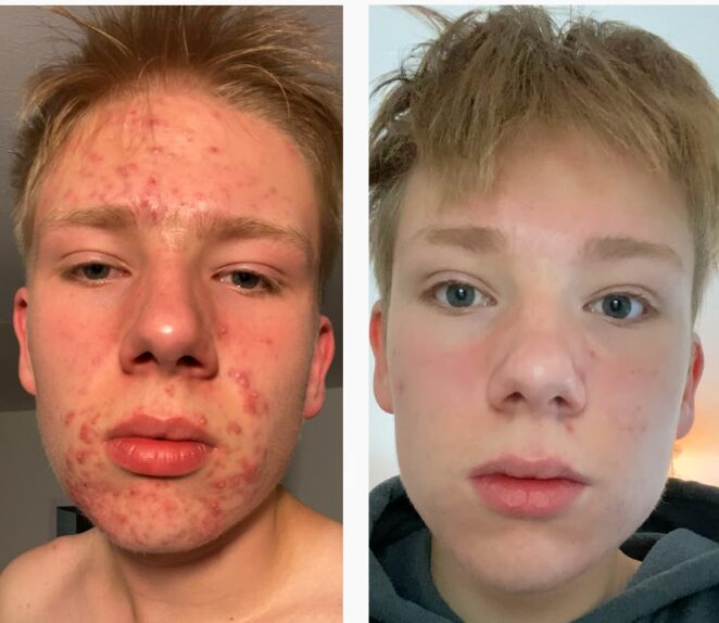 Avant / Après — Loïc, 16 ans