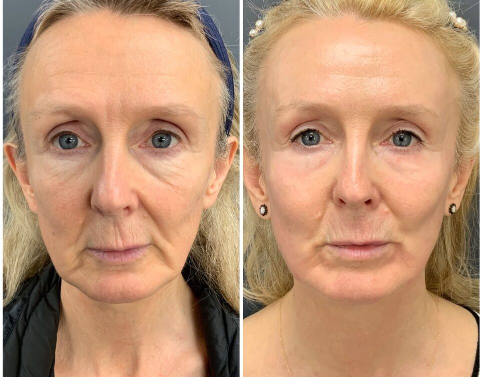 Avant / Après — Catherine, 58 ans