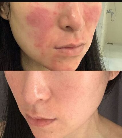 Avant / Après — Linh, 29 ans